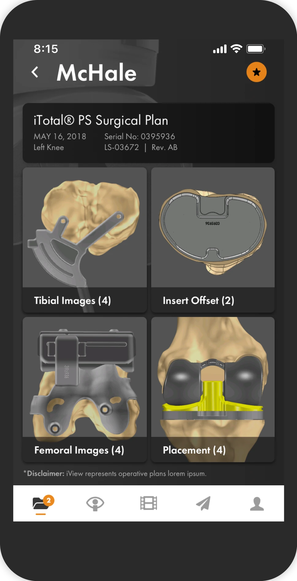 Phone showing a Conformis iViewer surgical plan screen with tiles for tibial images, insert offset, femoral images and placement